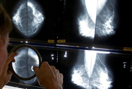 400,000 fewer mammograms during pandemic, more advanced cancer now seen: OMA