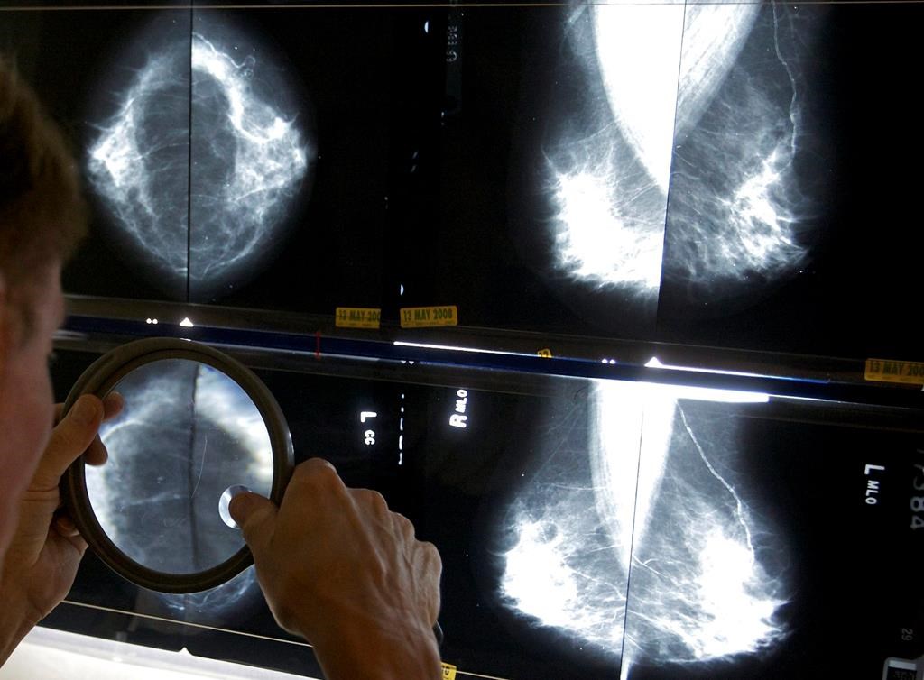 400,000 fewer mammograms during pandemic, more advanced cancer now seen: OMA